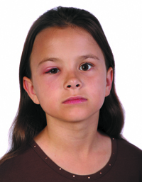 Pink Eye - Conjunctivitis - The Simple Details And Also The Cures