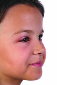 Pink Eye - Conjunctivitis - The Simple Details And Also The Cures
