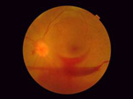 Are you Diabetic? Get your eyes screened for Diabetic eye disease today?