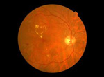 Are you Diabetic? Get your eyes screened for Diabetic eye disease today?
