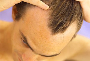 Hair-loss and andropause