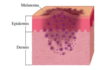 The Causes and Symptoms of Melanoma