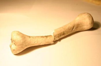Bone-Breaking-Disease-Osteoporosis