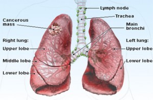 Lung Cancer- The Real Facts