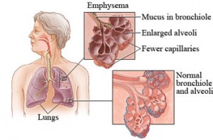 Emphysema---Problem-Caused-To-Your-Lungs