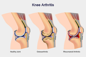 Knee Arthritis and How It Affects You