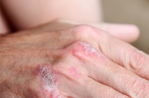Psoriasis - Escape This Disease to Enjoy Fresh And Healthy Skin