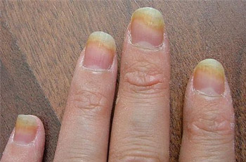 Finger Nail Fungus
