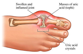 Disease of the Rich - Gout