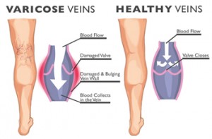 The Truth about Varicose Veins