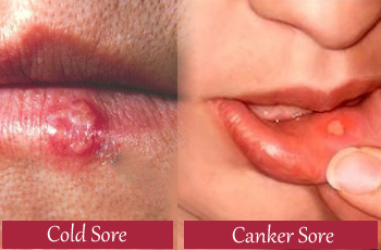 cold-sore-and-canker-sore