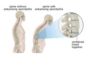 Ankylosing Spondylitis