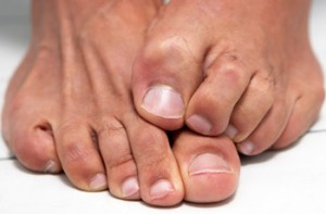 Causes and Prevention of Toenail Fungus