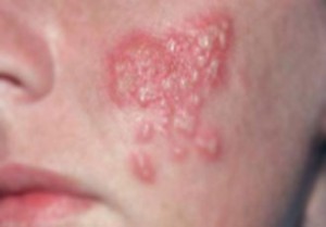 Herpes Simplex- Some Quick Facts