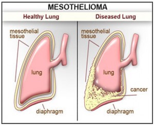 mesothelioma cancer