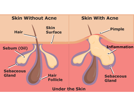Acne vulgaris